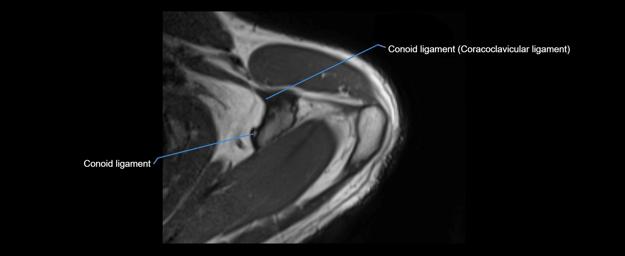shoulder ligaments axial 3d 3t mri image-img-00005-00031.webp